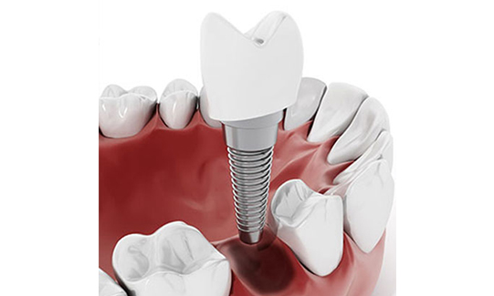 baulkham hills high quality dental implant