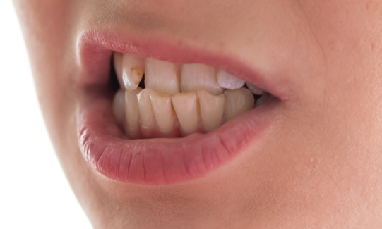 bottom teeth extending beyond upper teeth treatement in castle hill