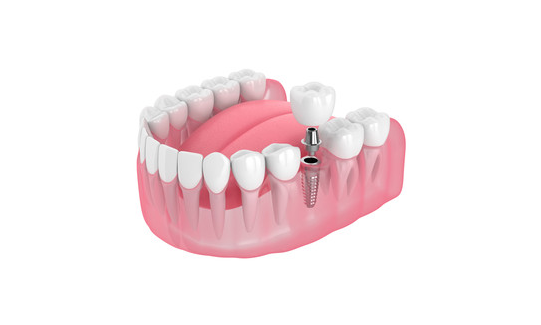 castle hill single tooth dental implant