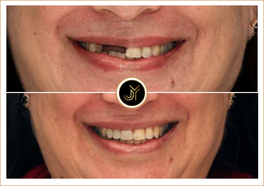 castle hills dental implant