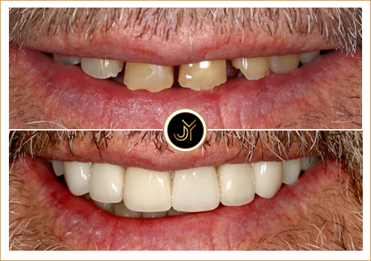 dental implant in kellyville