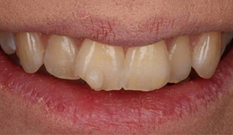 glenwood missing brighter teeth treatment