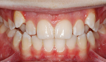 glenwood missing crooked teeth treatment