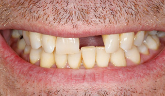 glenwood missing teeth treatment
