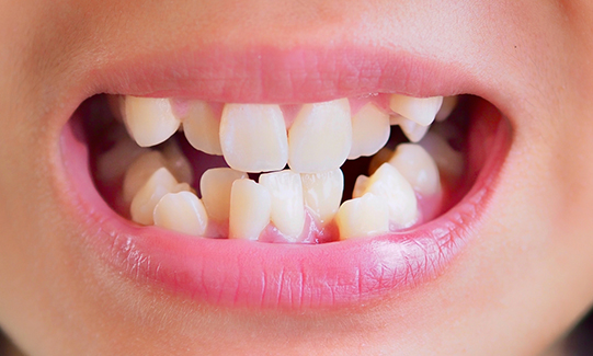 top teeth protruding beyond lower teeth treatment in castle hill