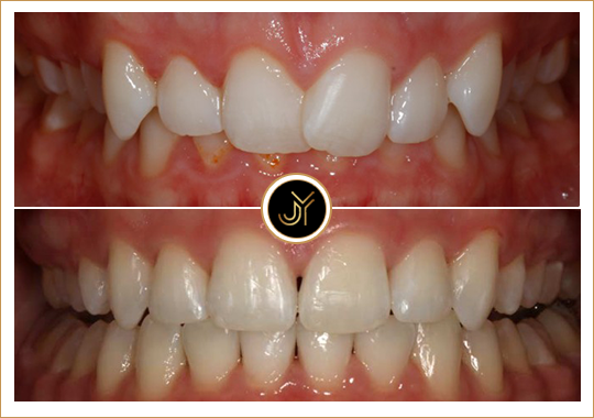 veneers services in castle hill