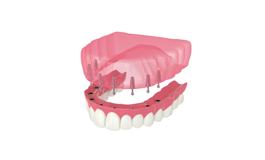 winston hills implant supported dentures