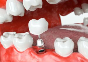 Dental Implants Thailand cost