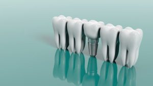 Cost Of Dental Implants In Australia images bella vista