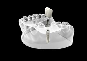 single tooth implant cost australia illustration bella vista