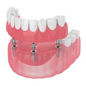 all 4 dental implants cost amount bella vista