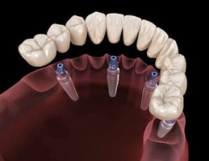 All On 4 Dental Implants placement bella vista